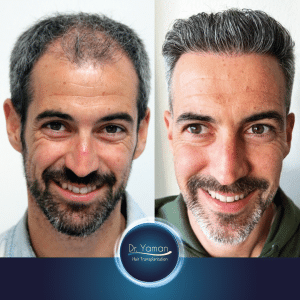 Trasplante Capilar en Turquía: Antes y Después